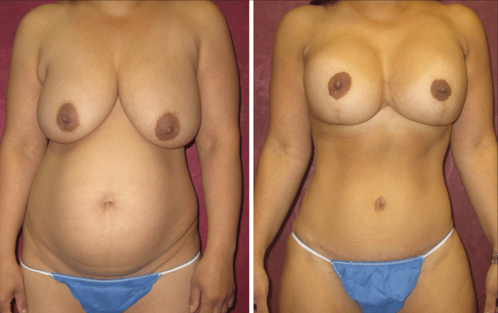 Tummy Tuck and Breast Augmenta